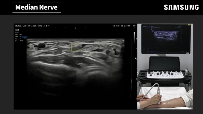 Demonstration of NerveTrack™ ultrasound for median and ulnar nerve identification