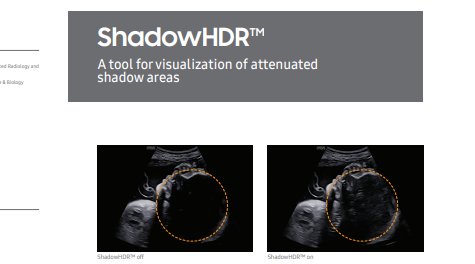 Report on ShadowHDR™ for reducing ultrasound shadows and improving tissue visibility