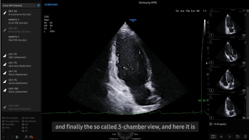 Case study on cardiovascular ultrasound with AutoEF and strain imaging on Samsung V8