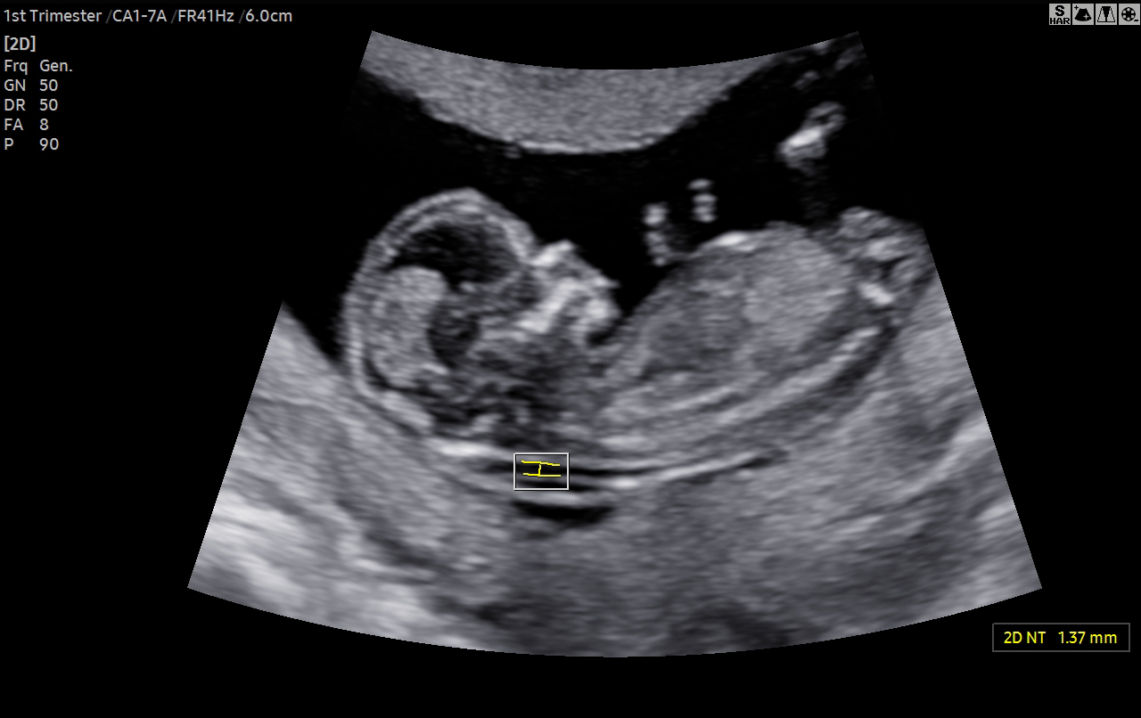 Nuchal translucency ultrasound (2D NT) in the 1st trimester with HERA W10 Elite showing fetal NT measurement for prenatal screening