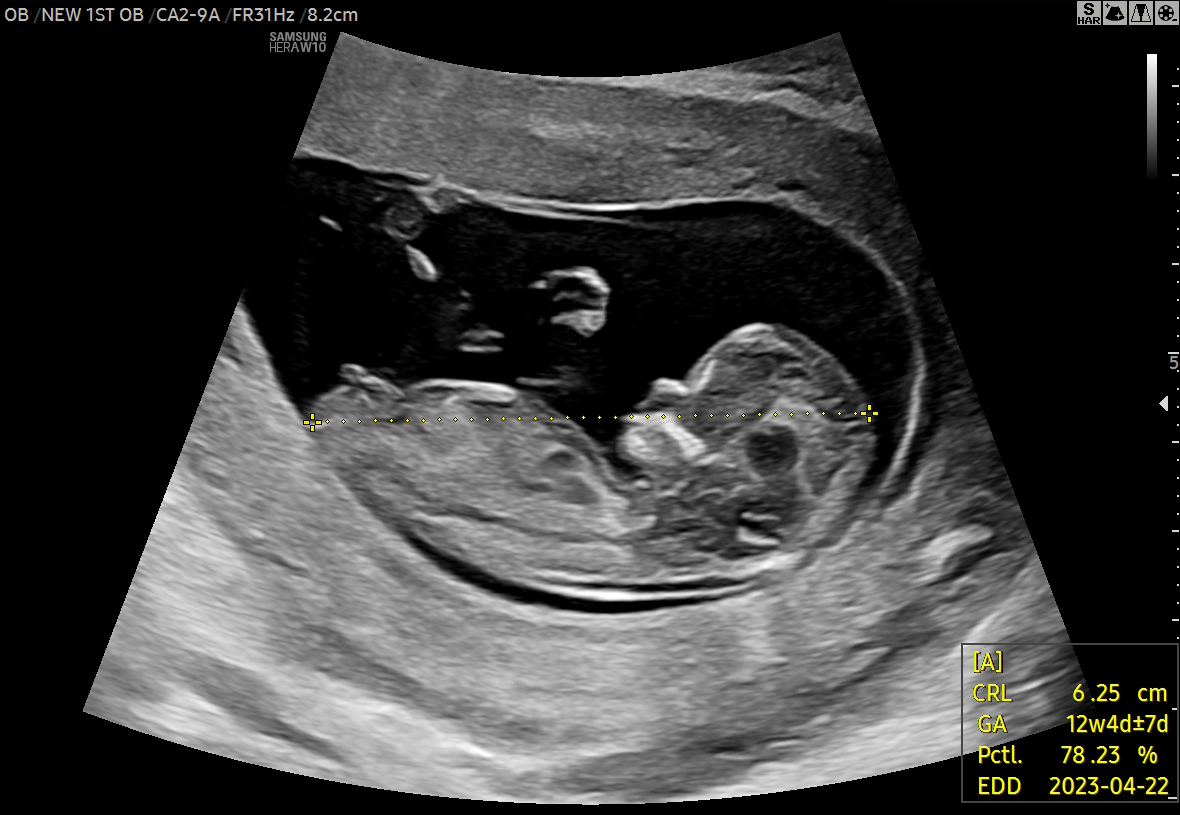 Fetal biometry ultrasound in the 1st trimester with BiometryAssist™ on HERA W10 Elite showing crown-rump length measurement for prenatal evaluation