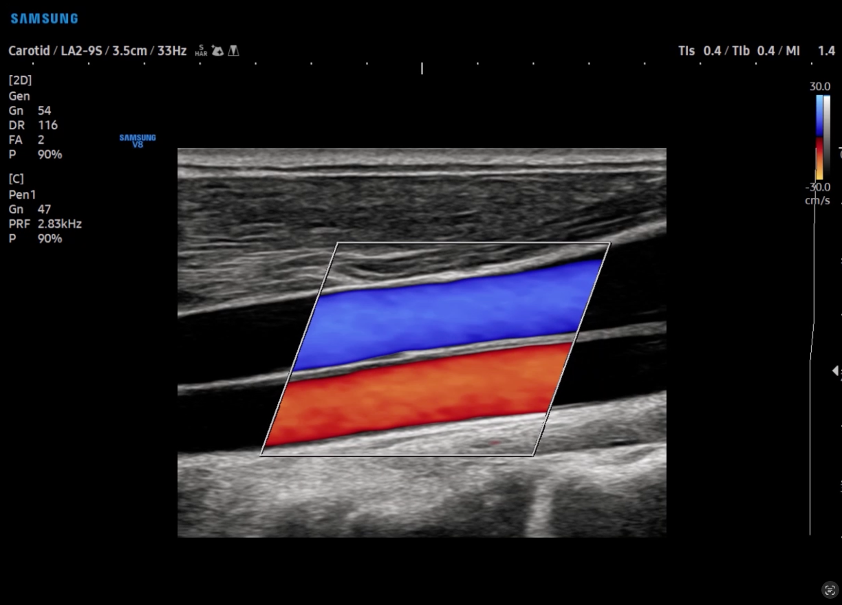 Carotid ultrasound in C-mode on Samsung V8 showing enhanced blood flow visualization.