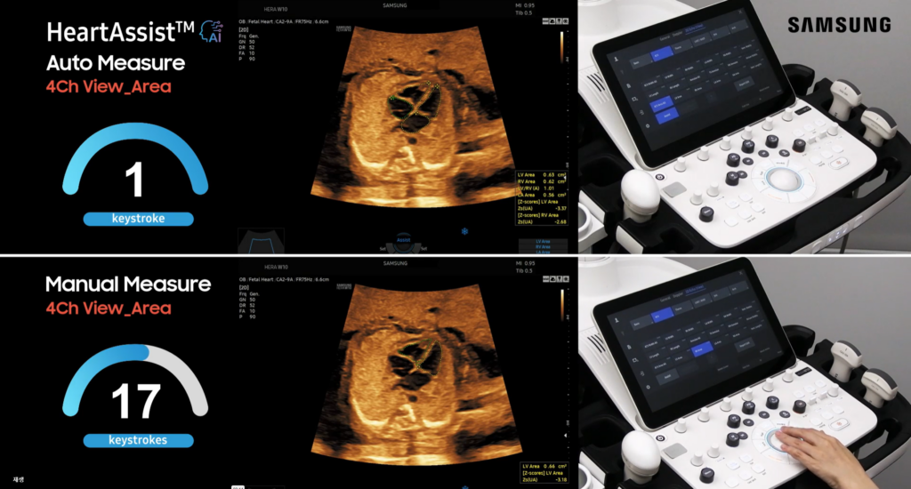 Tutorial video on reducing keystrokes in fetal echocardiogram using HeartAssist for fetal heart ultrasound