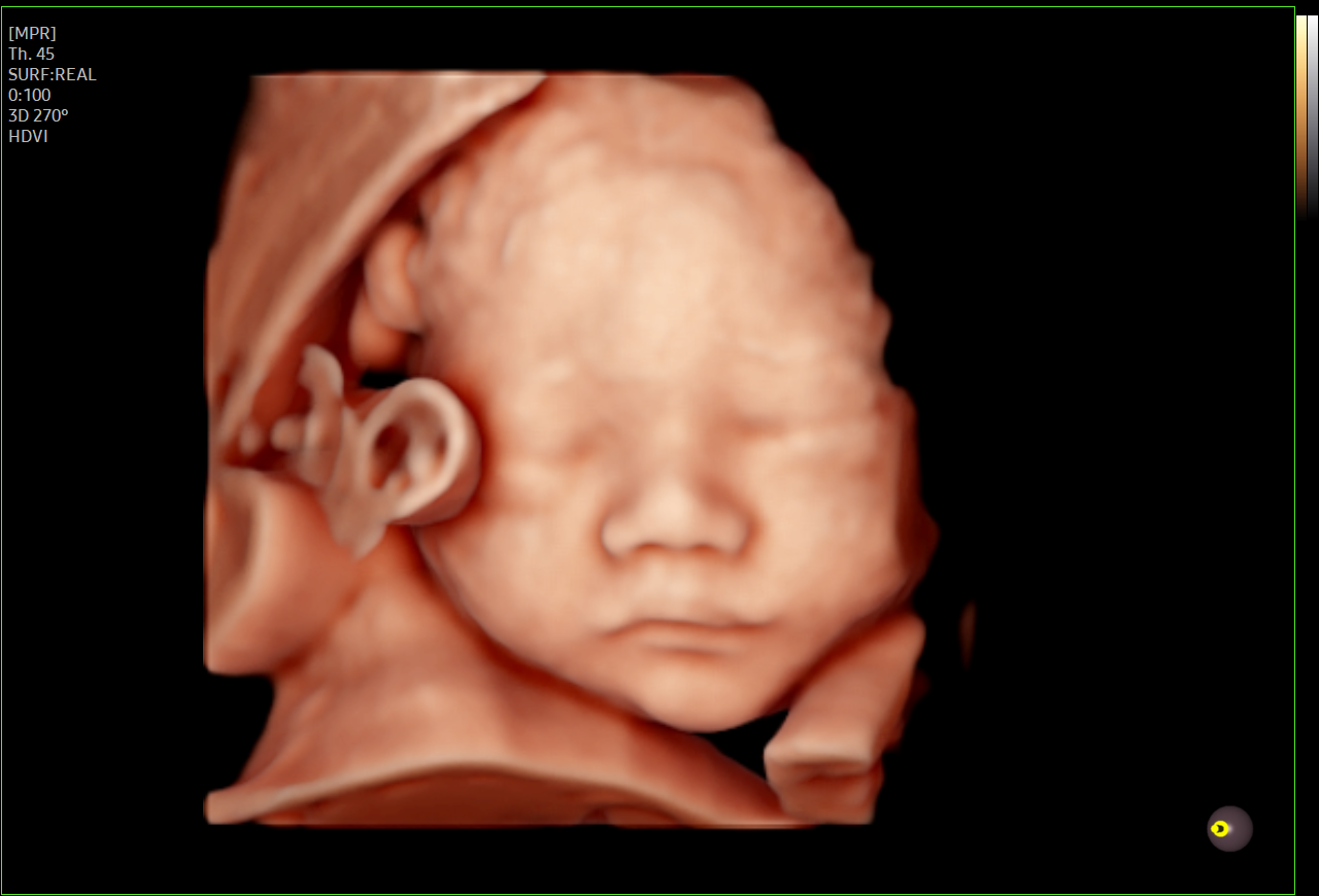 Fetal face ultrasound in 3D with RealisticVue on HERA Z20 showing lifelike prenatal imaging.