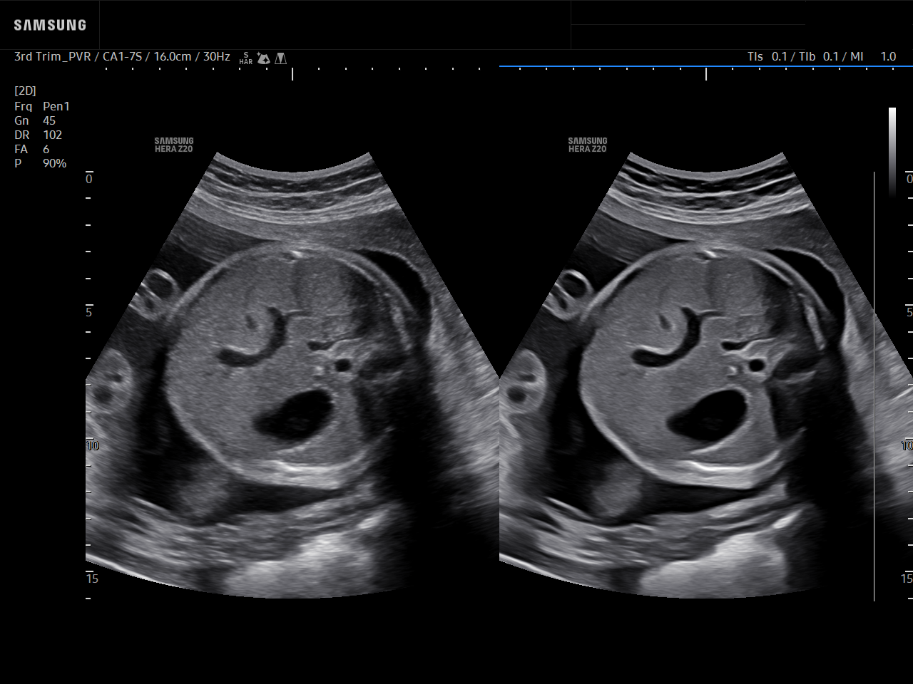 Ultrasound image of fetal abdomen (AC plane) with ClearVision on HERA Z20 showing enhanced detail for abdominal circumference measurement