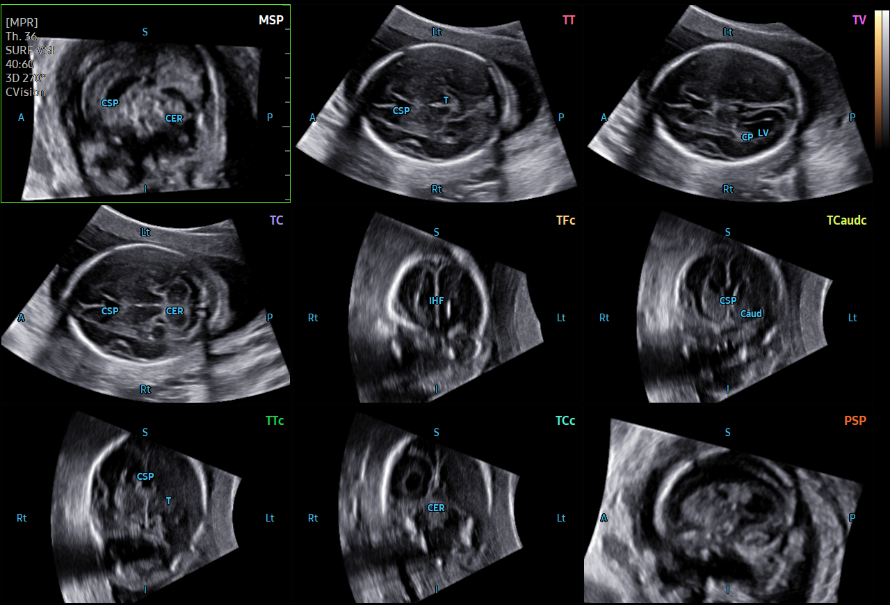 Fetal brain ultrasound with 5D CNS+™ showing automated multi-plane neurosonography views