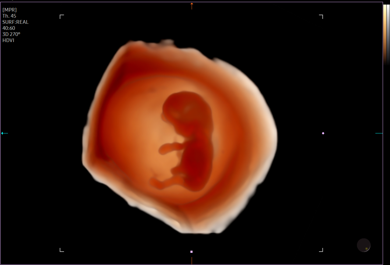 Ultrasound image of embryo with CrystalVue™ on HERA Z20 showing 3D visualization of early pregnancy development