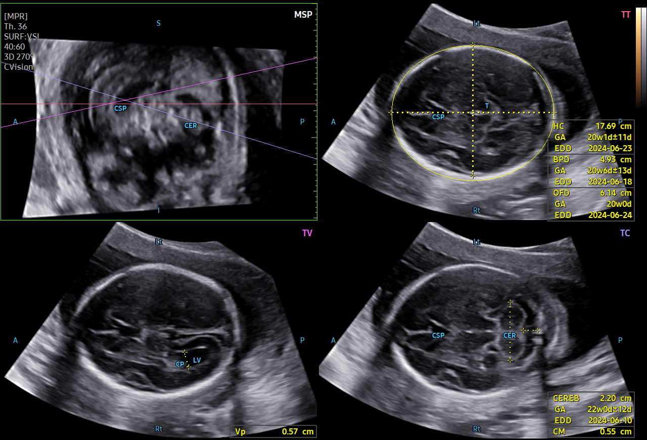 Ultrasound images of the fetal brain with 5D CNS+™ on HERA Z20 showing multiple views and automated measurements for prenatal evaluation