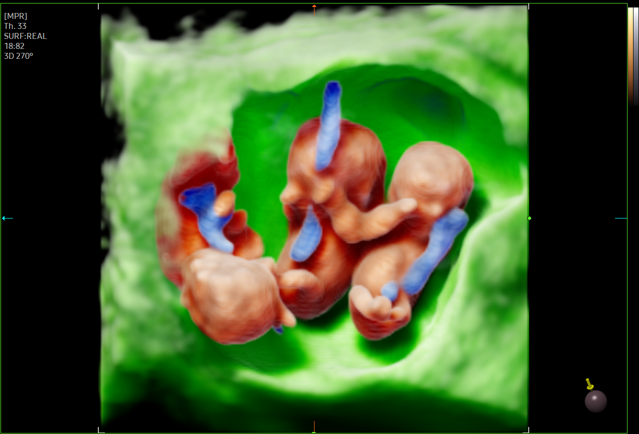 3D fetal ultrasound showing triplet pregnancy using EzVolume™