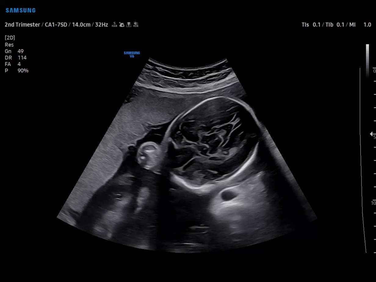 Ultrasound of fetal brain in B-mode on Samsung V6 showing second trimester obstetric scan