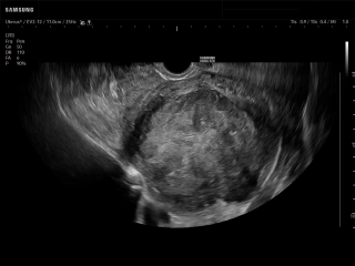 Ultrasound image of myoma in B-mode on HERA Z20 showing uterine fibroid during transvaginal gynecologic scan