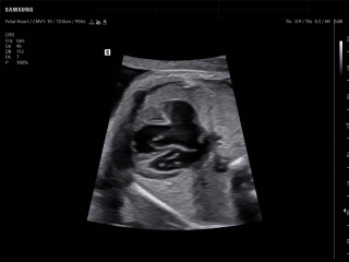 Fetal heart ultrasound with write zoom imaging on HERA Z20 showing complex cardiac anomaly