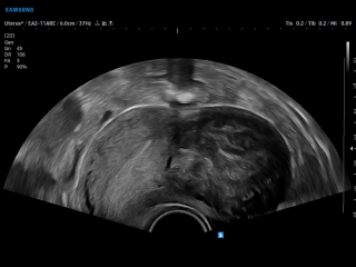Uterine myoma ultrasound in B-mode on V6 system showing large fibroid