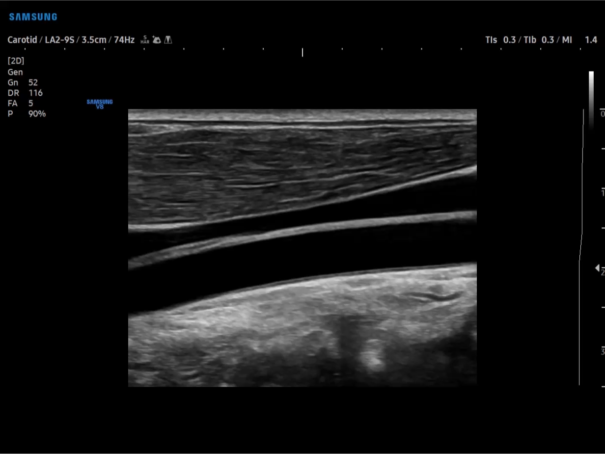Ultrasound image of carotid artery in B-mode on V8 system showing vessel wall and lumen for vascular evaluation