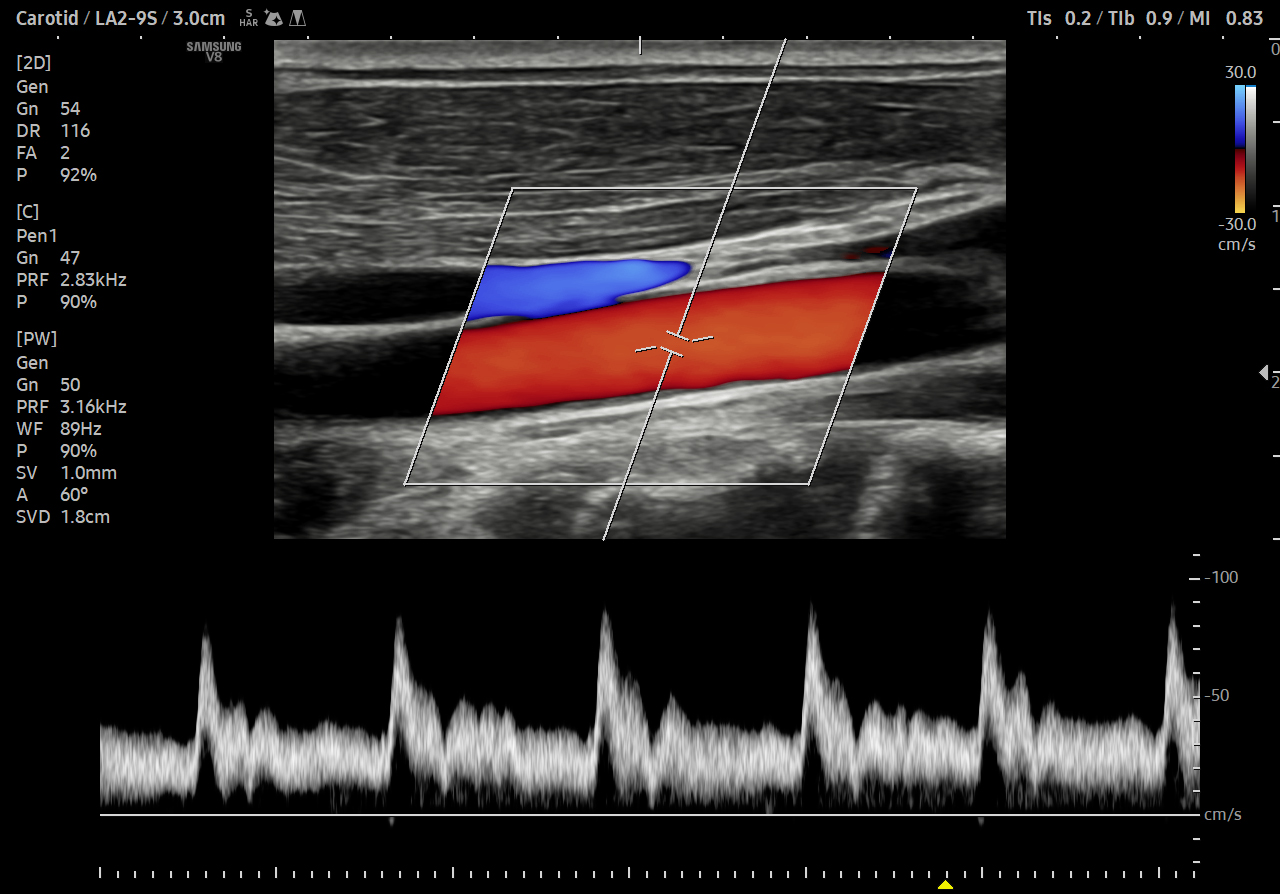 Carotid ultrasound with color and PW Doppler on V8 system showing blood flow and velocity