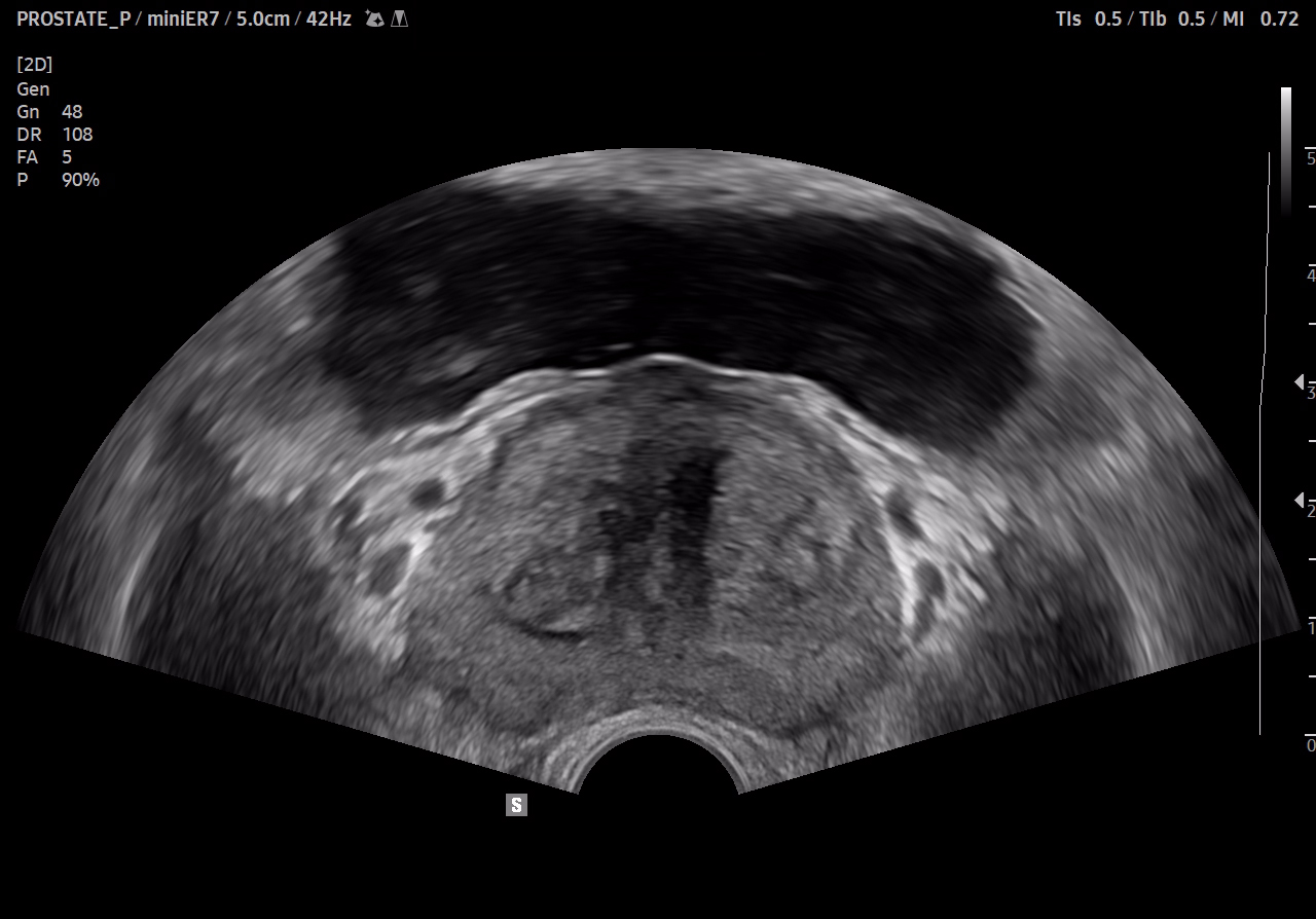 Prostate cancer ultrasound with miniER7 on RS85 Prestige showing detailed prostate imaging for urology assessment