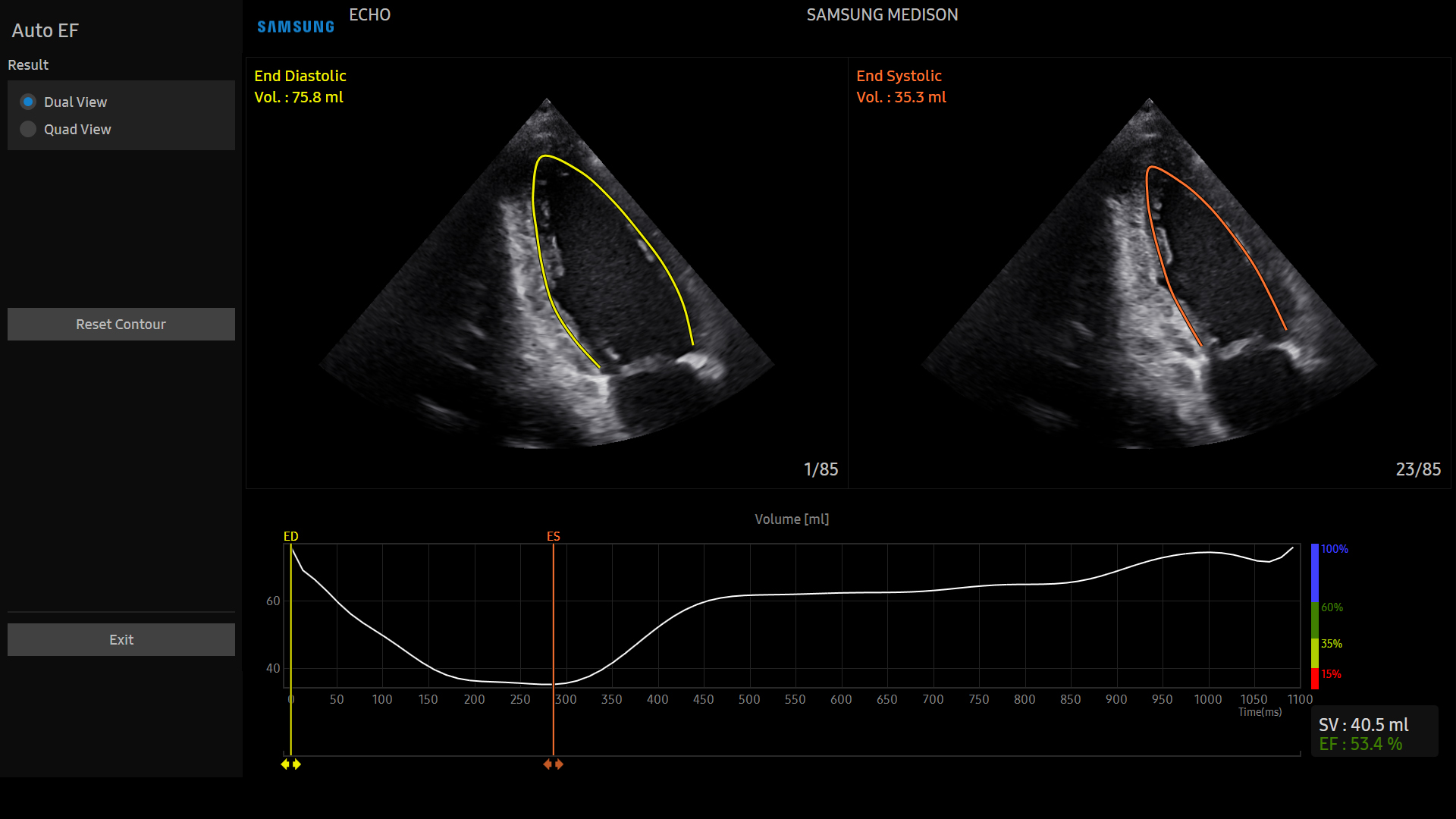 Echocardiography of adult heart with AutoEF on Samsung V8 showing automated ejection fraction measurement