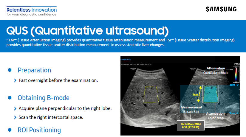 Quick Overview on Quantitative Ultrasound for liver steatosis evaluation using QUS with TAI and TSI