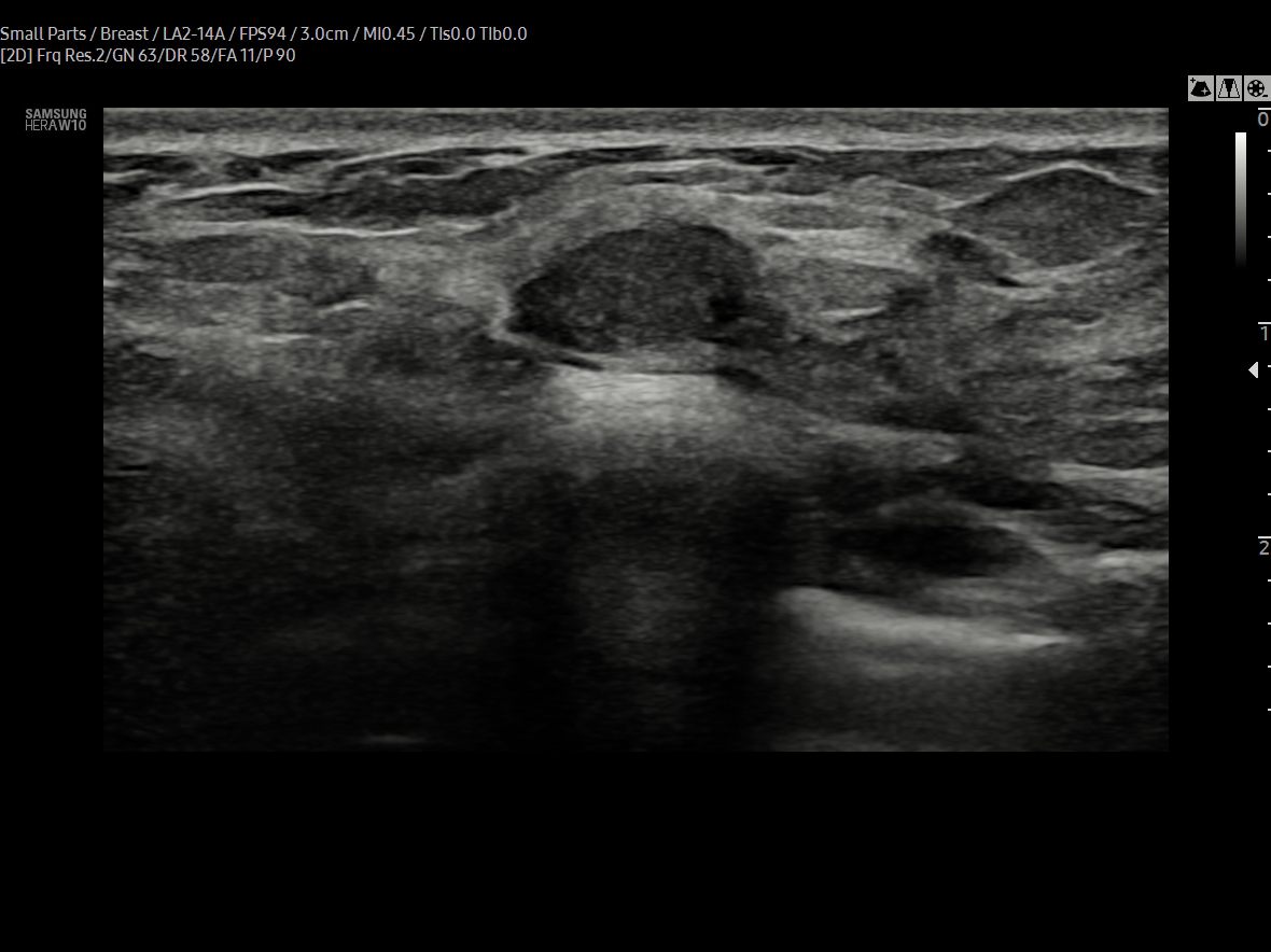 Breast fibroadenoma ultrasound in B-mode on HERA W10 Elite showing benign breast lesion imaging