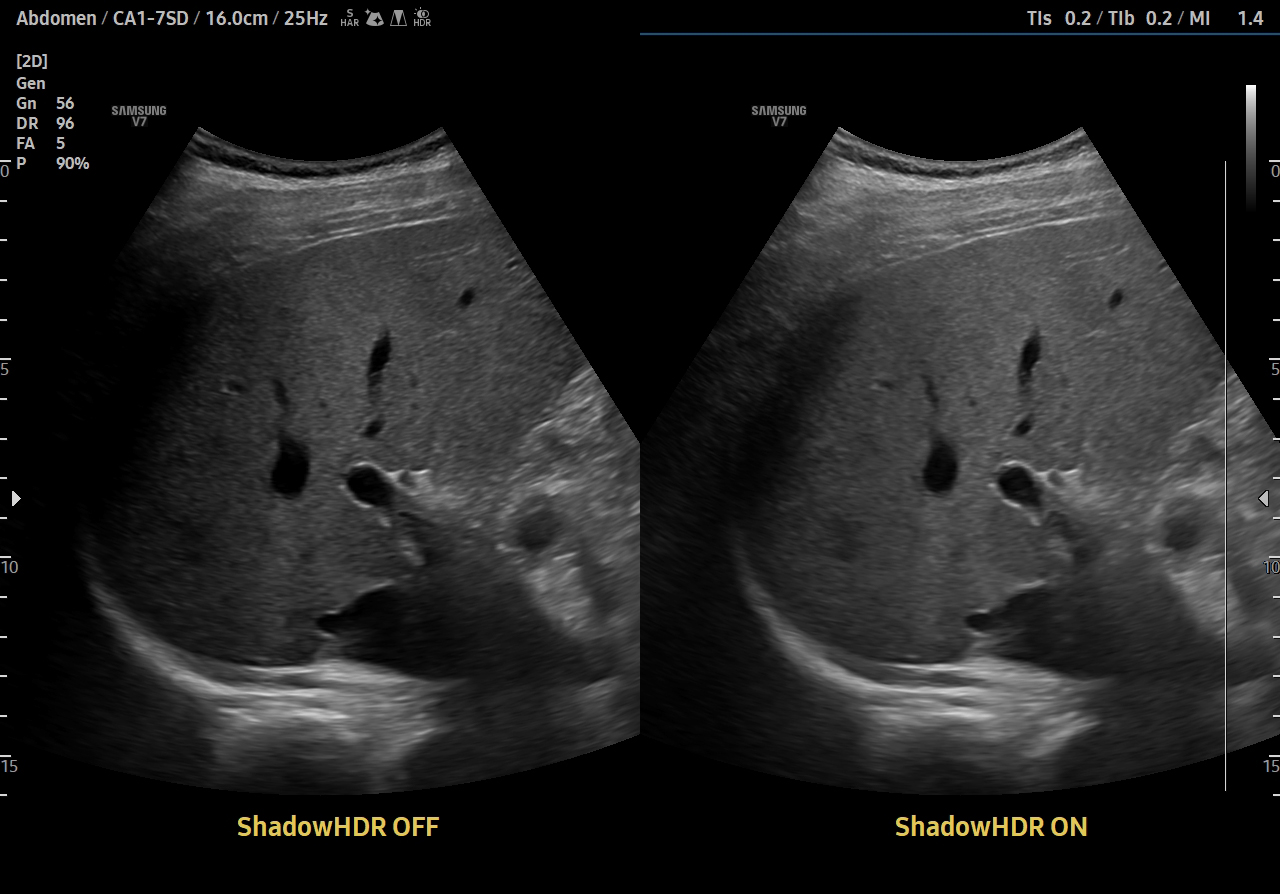Liver ultrasound with ShadowHDR on Samsung V7 showing improved shadow visualization for clearer diagnostic imaging.