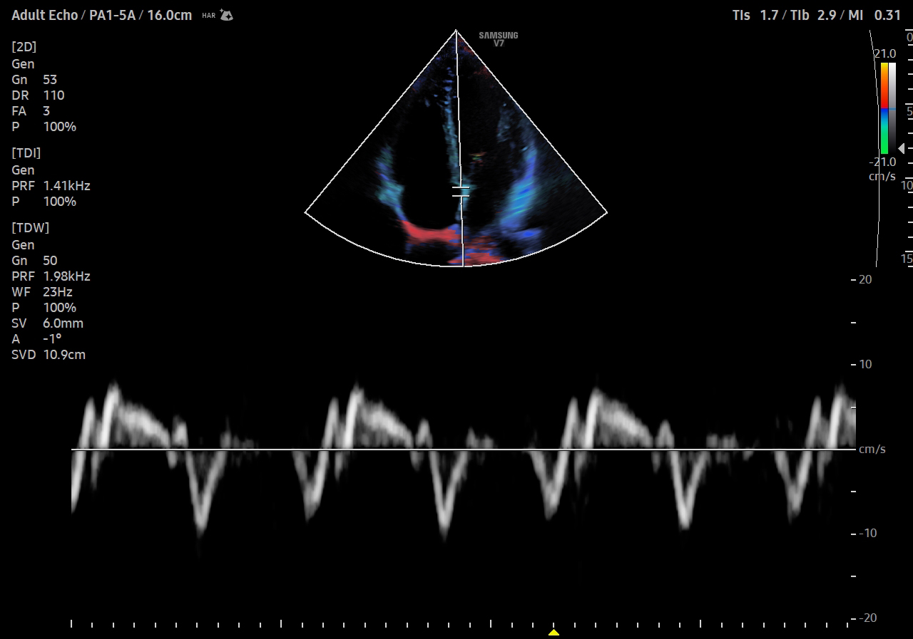 Tissue Doppler echocardiography of adult heart with PW Doppler on V7 showing myocardial velocity imaging for cardiac evaluation