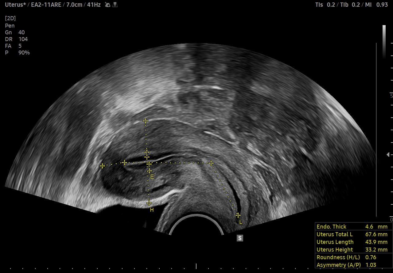 Uterus ultrasound with UterineAssist™ on V6 showing automated uterine and endometrial measurements for gynecologic evaluation