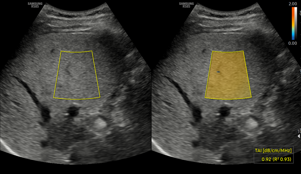 Ultrasound of fatty liver with TAI™ showing grayscale and color-coded attenuation mapping on RS85 Prestige