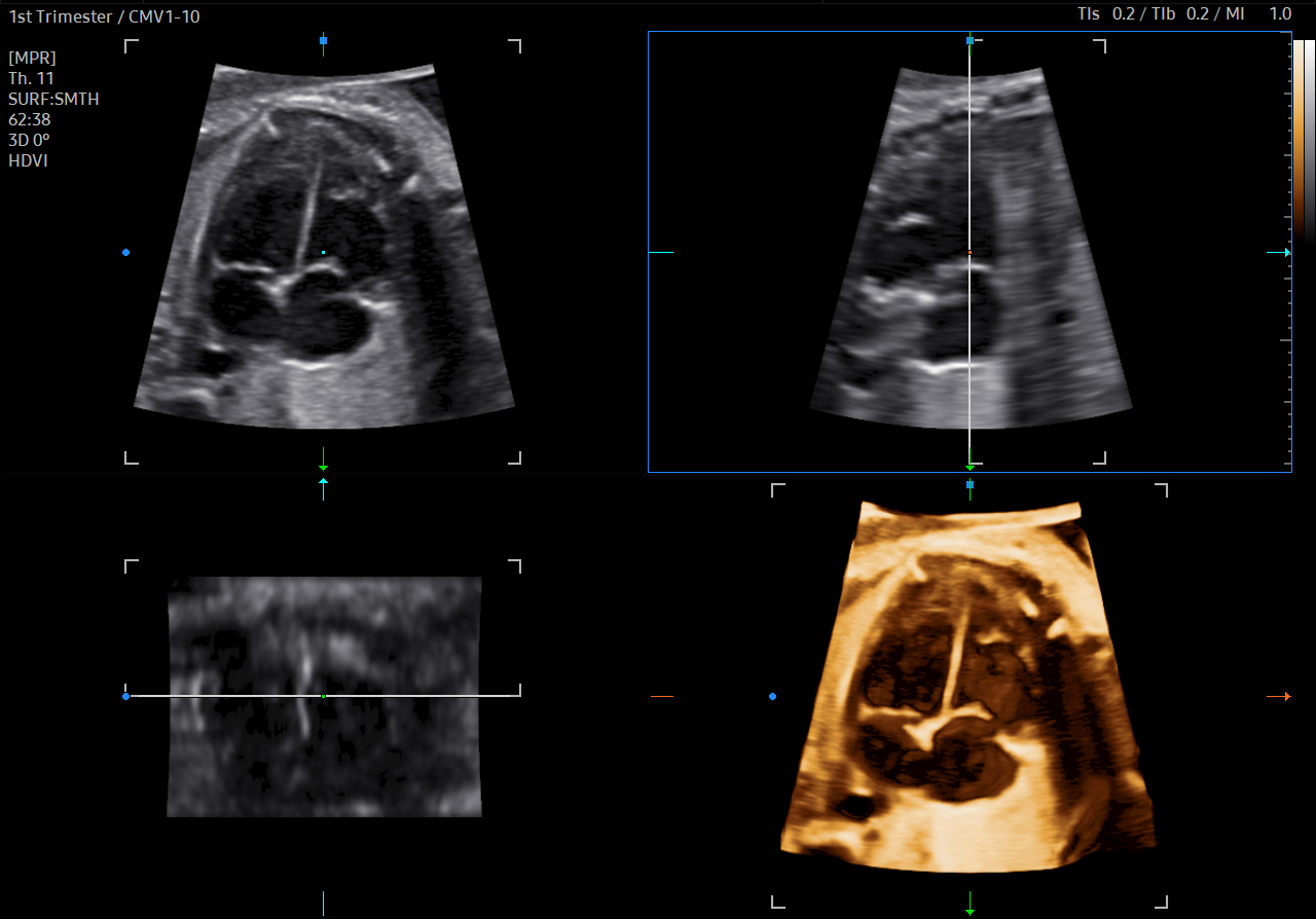 Fetal heart ultrasound in the 1st trimester using STIC on HERA Z20