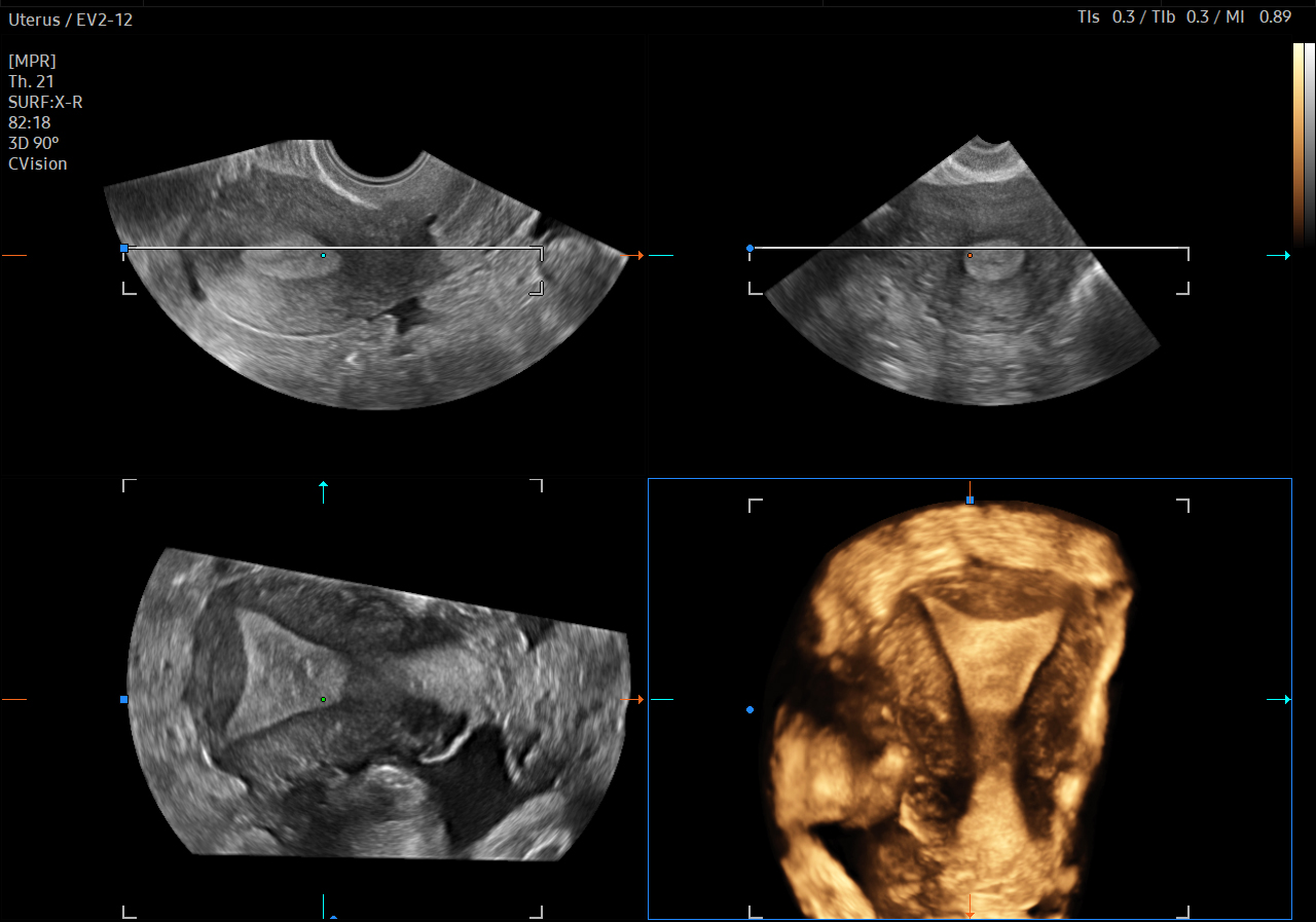 Uterus ultrasound with 3D MPR multi-planar rendering on HERA Z20