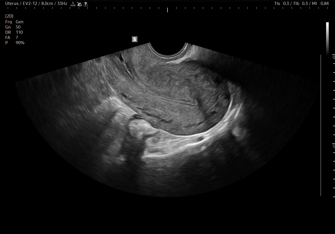 Uterus ultrasound in B-mode on HERA Z20 showing transvaginal longitudinal uterine imaging for gynecologic evaluation