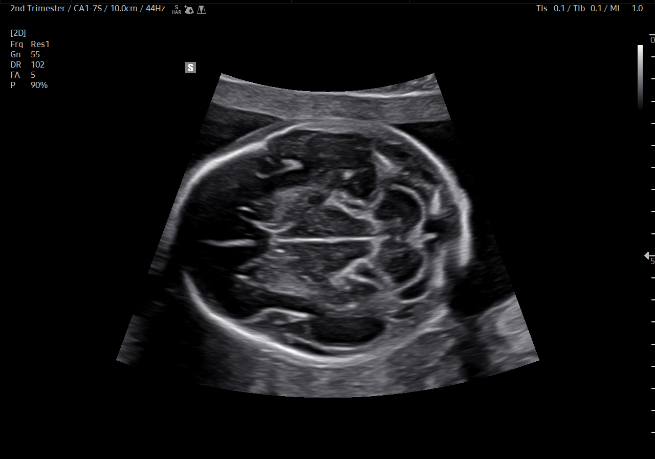 Fetal brain ultrasound in transcerebellar view on HERA Z20 showing second trimester neurosonography
