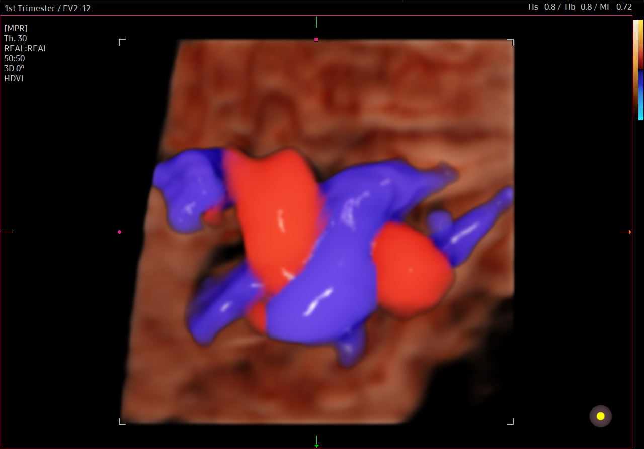 Umbilical cord ultrasound in 3D with RealisticVue™ on HERA Z20 showing fetal circulation