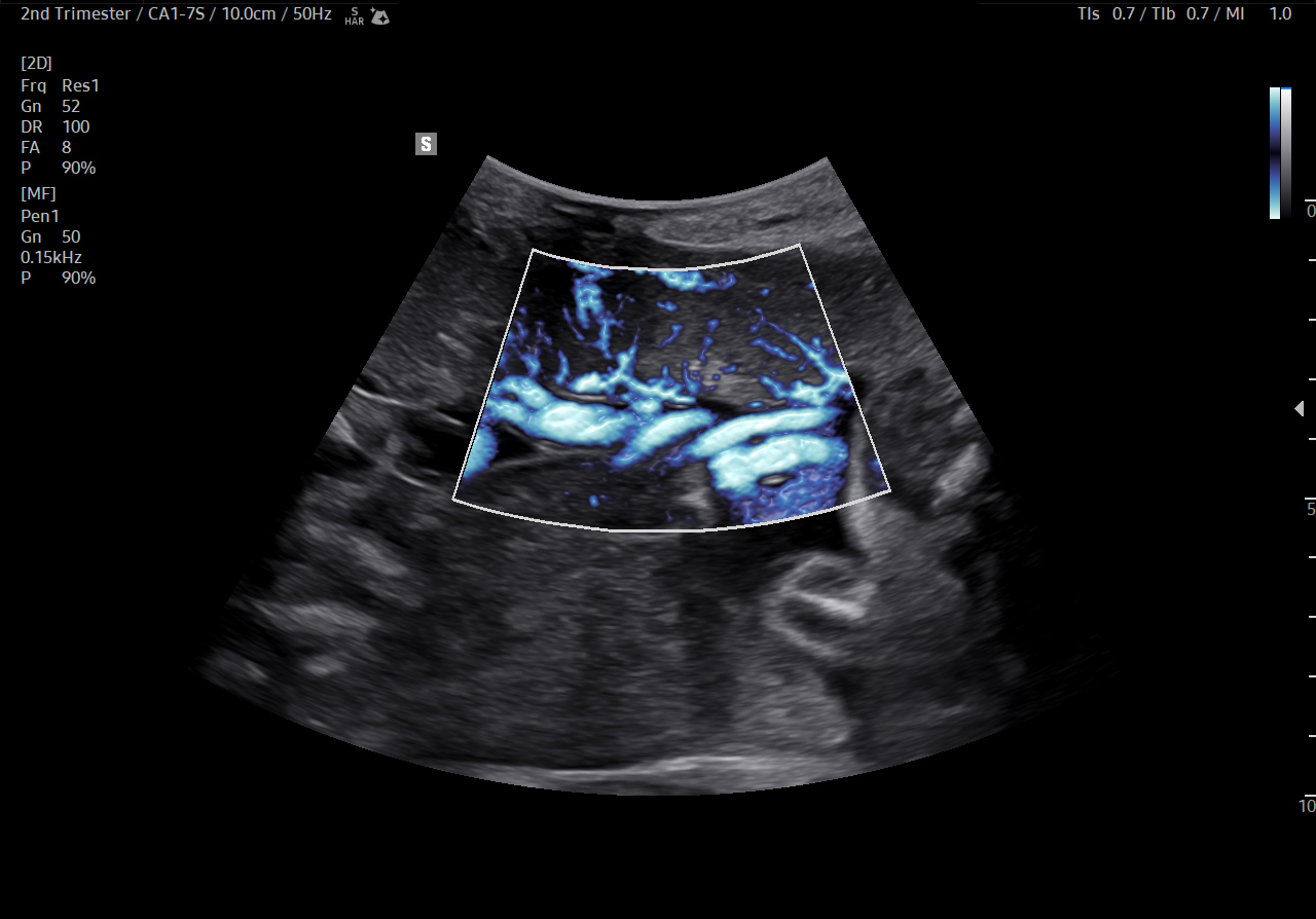 Ultrasound image of umbilical cord and placenta with MV-Flow™ on HERA Z20 showing detailed blood flow for obstetric evaluation