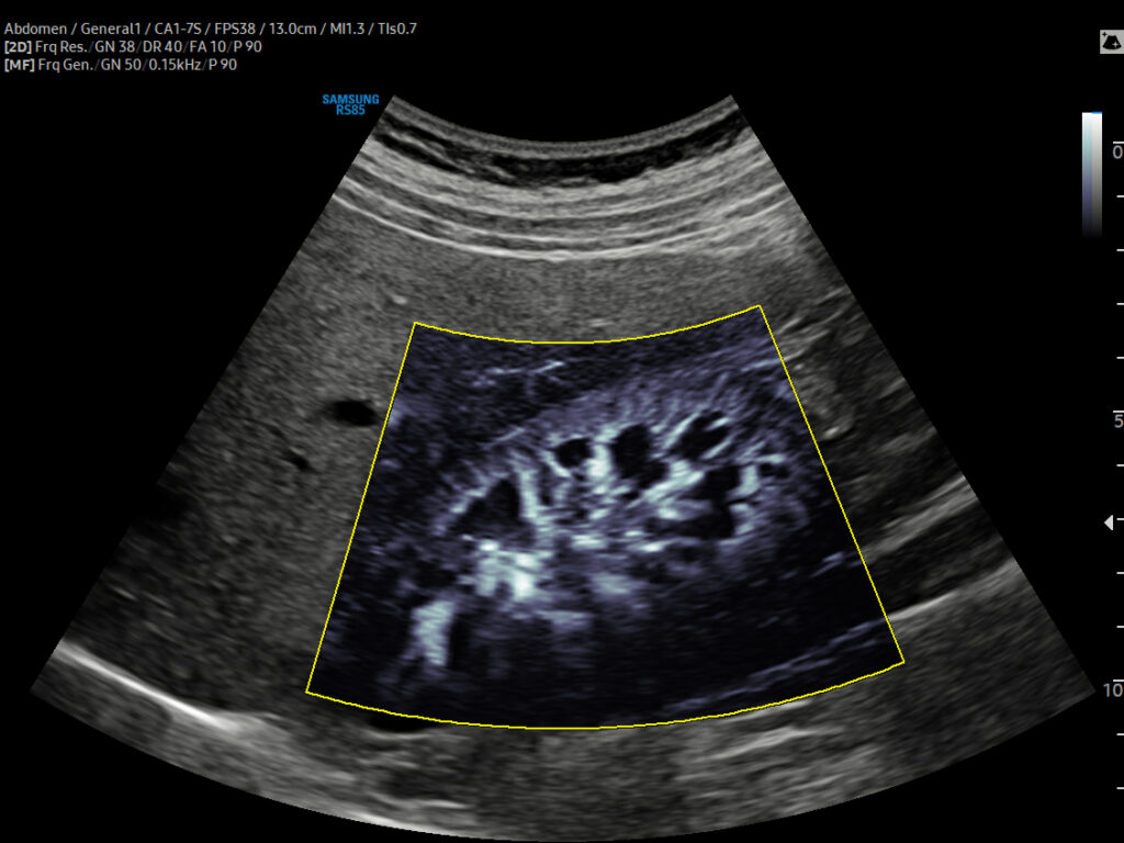 Kidney ultrasound with MV-Flow™ technology highlighting blood vessel structure and perfusion, captured with RS85 Prestige ultrasound machine.