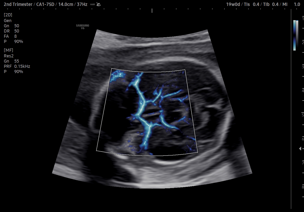 Ultrasound of middle cerebral artery with MV-Flow™ on Samsung V6 showing fetal brain blood flow during obstetric scan