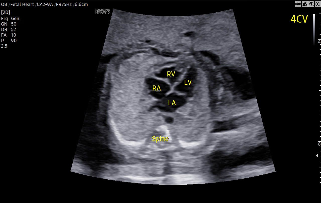 Fetal heart ultrasound with ViewAssist™ on HERA W10 Elite showing 4-chamber view for prenatal cardiac evaluation