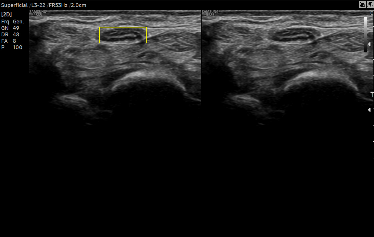 Median nerve ultrasound with NerveTrack™ on RS85 Prestige showing peripheral nerve imaging