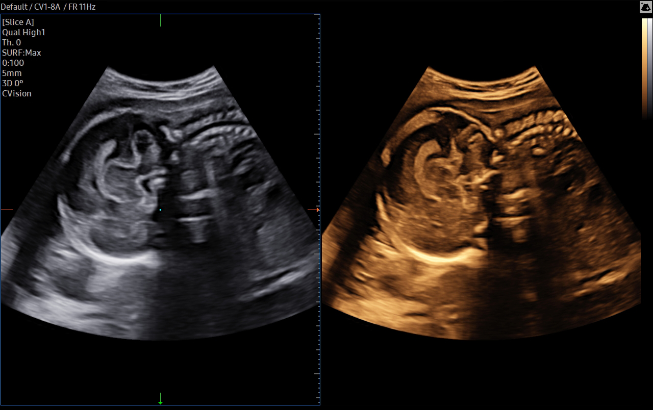Fetal brain ultrasound with Slice A on HERA W10 Elite showing detailed prenatal neurosonography for brain evaluation