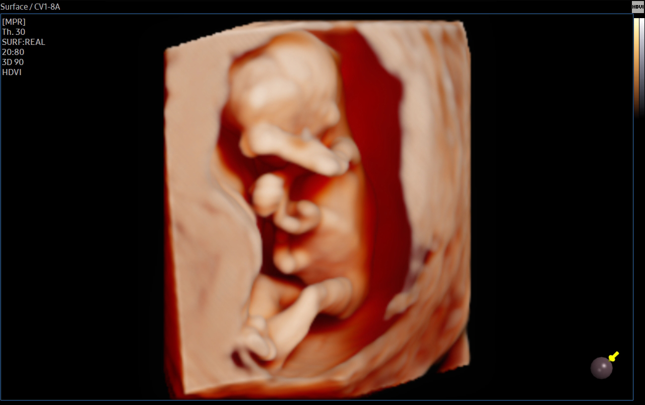 3D fetal ultrasound with RealisticVue™ on HERA W10 Elite showing lifelike rendering of a fetus for prenatal evaluation