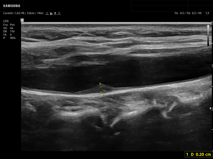 Ultrasound of a carotid intima media thickness measurement at the carotid bulb