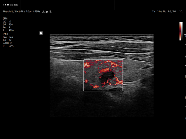 Thyroid nodule ultrasound using MV Flow showing microvascular flow patterns
