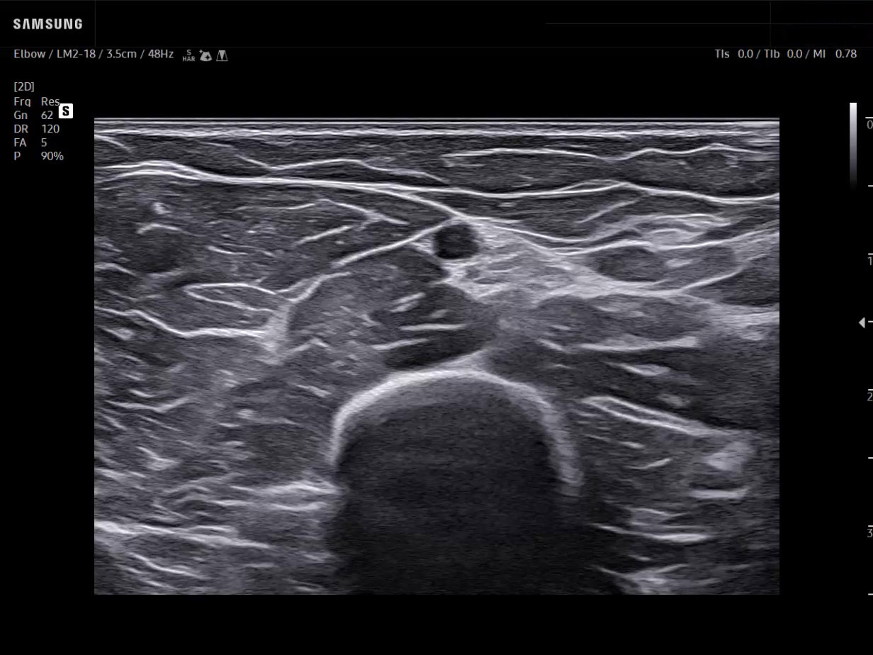 Elbow ultrasound showing median nerve and brachial artery in transverse view using Samsung R20 system