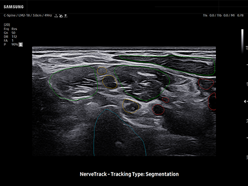 Brachial plexus ultrasound showing segmented nerve structures using NerveTrack™