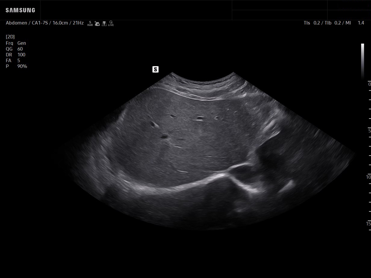 Liver hemangioma ultrasound showing subcostal WideView scan of hepatic lesion and surrounding anatomy