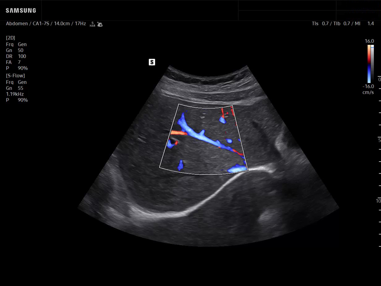 Hepatic vein ultrasound with S-Flow on Samsung R20, subcostal view showing liver vascular imaging.