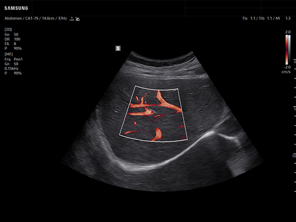 Hepatic vein ultrasound with MV-Flow on Samsung R20, subcostal view showing liver vascular imaging.