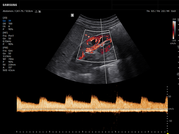 Renal artery ultrasound with PW Doppler on Samsung R20 showing blood flow and spectral waveform for vascular assessment.