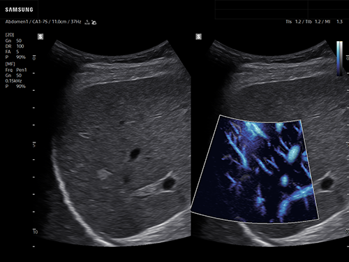 Hepatic hemangioma ultrasound with MV-Flow showing enhanced liver blood flow imaging on Samsung R20.