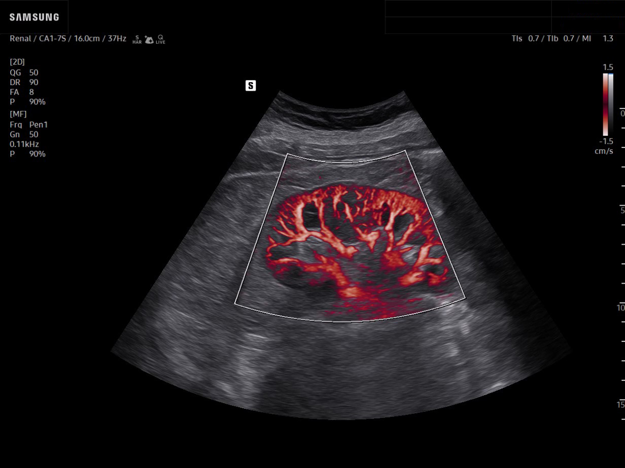 Kidney ultrasound with MV-Flow showing detailed blood flow visualization in red tone.