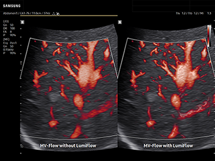 Liver ultrasound of hepatic hemangioma on Samsung R20 with MV-Flow and LumiFlow showing vascularity visualization.